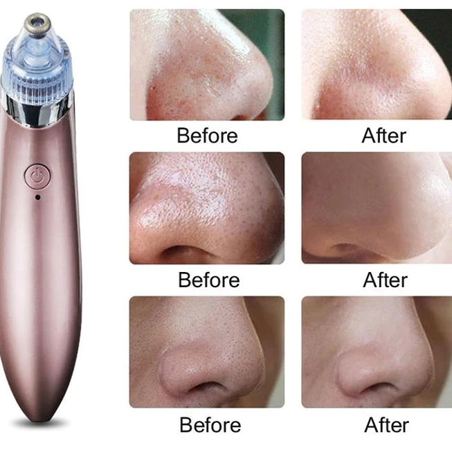 "GlowSkin™ Portable Blackhead Remover"
